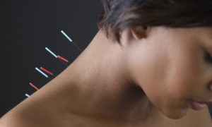 acupuncture